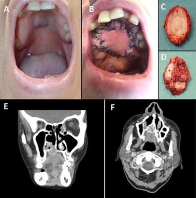 Surgical Navigation, Augmented Reality, and 3D Printing for Hard Palate Adenoid Cystic Carcinoma En-Bloc Resection: Case Report and Literature Review